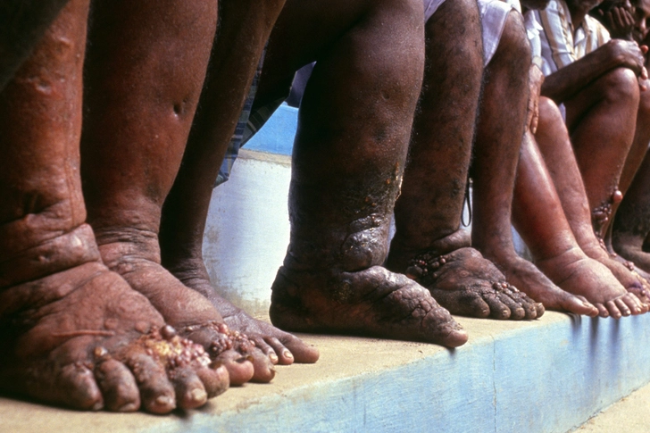 Lymphatic Filariasis Lymphatic Filariasis