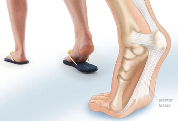 Problem: Plantar Fasciitis