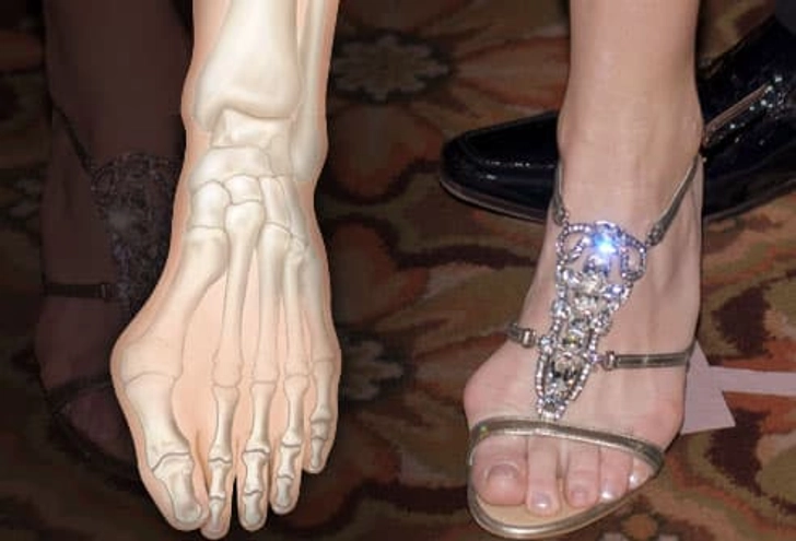 Problem: Bunions