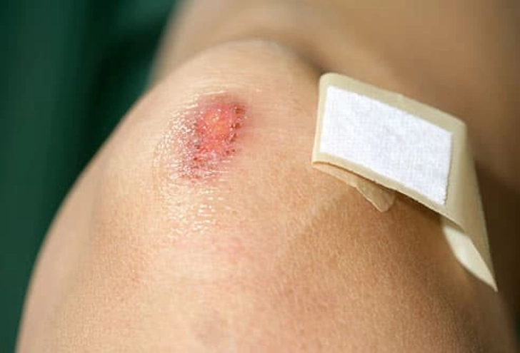 True or False? Scrapes Need to Air Out True or False? Scrapes Need to Air Out