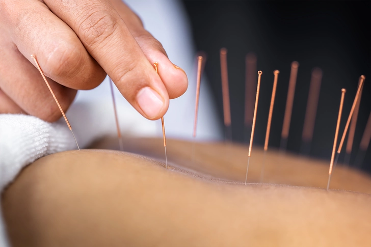 Acupuncture Acupuncture