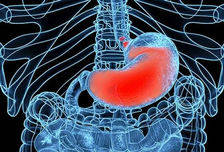 Acid Reflux