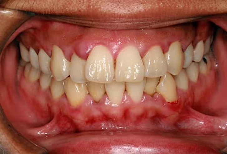 Gum Disease