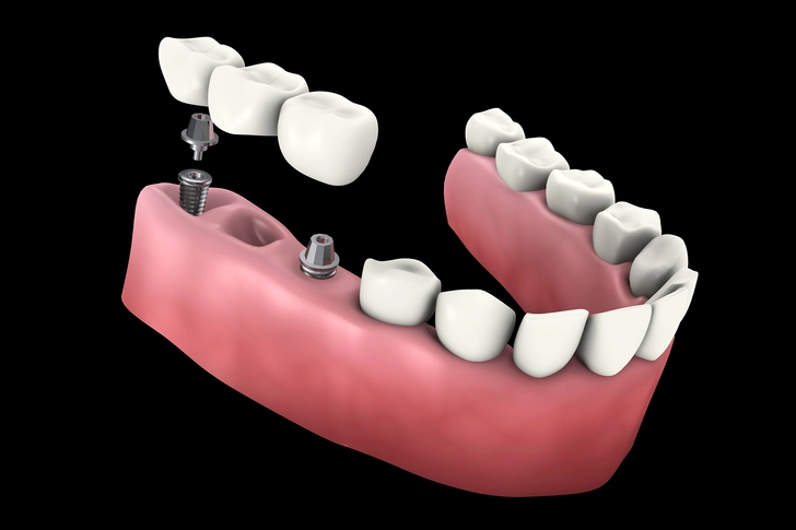 Implant Supported Bridge Implant Supported Bridge