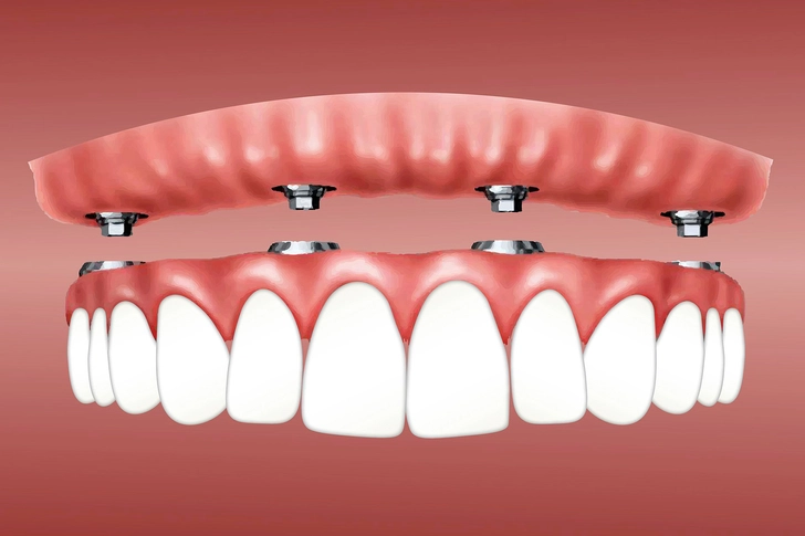 Overdentures