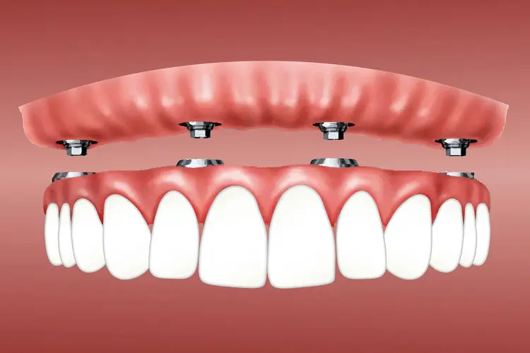 Image of Snap in dentures