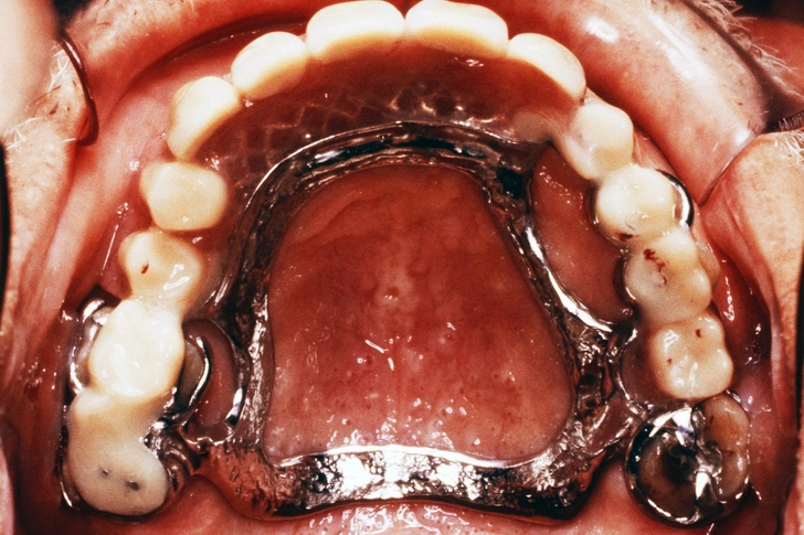 Partial Dentures