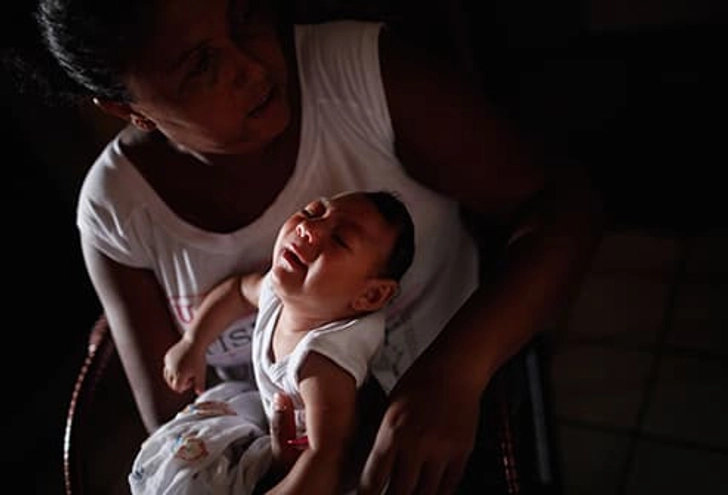 Microcephaly Microcephaly