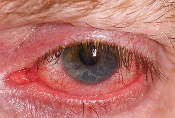 Symptoms Symptoms
